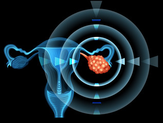 Poster - Cancer in ovary of woman