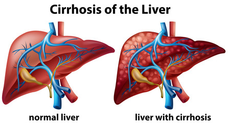 Wall Mural - cirrhosis of the liver poster
