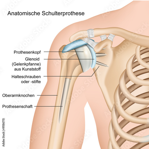 Fototapeta na wymiar Anatomische Schulterprothese, Illustration mit Beschreibung