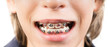 Smile with braces - Sorriso con apparecchio ortodontico