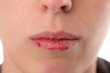 Nahaufnahme Gesicht einer Frau mit trockenen aufgerissenen Lippe
