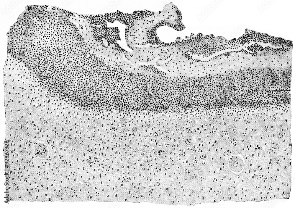 Section of human brain including wall of cerebral abscess, vinta Stock ...