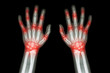 Rheumatoid arthritis , Gout arthritis  ( Film x-ray both hands of child with multiple joint arthritis ) ( Medical , Science and Health care concept )