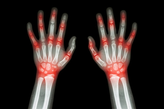 Fototapete - Rheumatoid arthritis , Gout arthritis  ( Film x-ray both hands of child with multiple joint arthritis ) ( Medical , Science and Health care concept )
