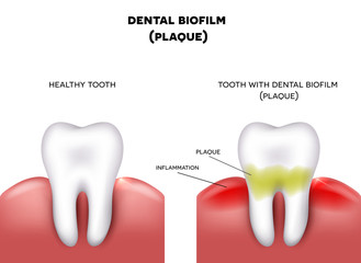 Sticker - Dental plaque with inflammation and healthy tooth on a white background