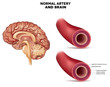 Normal artery structure and brain