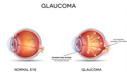 Canvas Print - Glaucoma