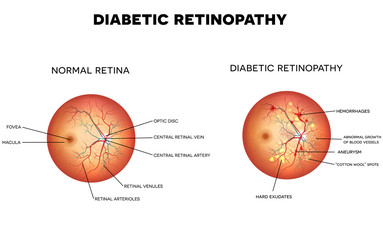 Canvas Print - Diabetic retinopathy