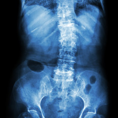 Naklejka na meble Spondylosis and Scoliosis ( film x-ray lumbar - sacrum spine show crooked spine ) ( old patient ) ( Spine Healthcare )
