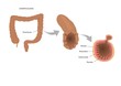 patologia intestinale: diverticolosi del colon