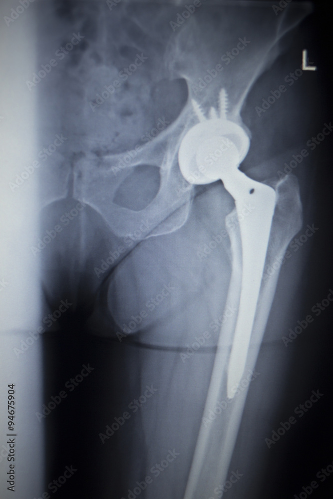 X-ray scan  image of hip joint replacement orthopedic implant