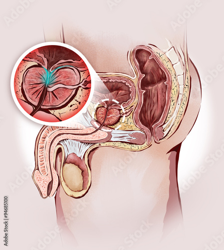 prostata ingrossata