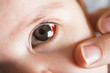 Derrame ocular o hiposfagma en un bebé, enfermedades y cuidado de la vista