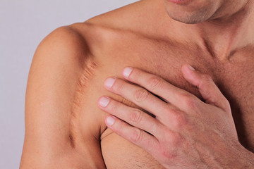 Man  man with scar on his  hand shoulder. Laser Scar Reduction concept