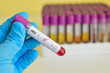 HIV positive blood sample