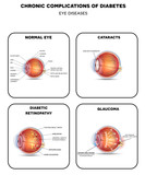 Fototapeta  - Diabetic Eye Diseases. Diabetic retinopathy,  cataract and glaucoma. Also healthy eye detailed anatomy.