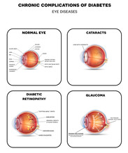 Diabetic Eye Diseases. Diabetic Retinopathy,  Cataract And Glaucoma. Also Healthy Eye Detailed Anatomy.