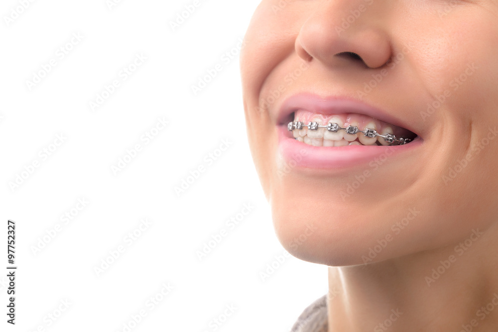 Teeth with dental braces Stock Photo | Adobe Stock
