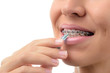 Dental Hygiene of Teeth with Braces