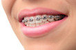 Close-up teeth with braces