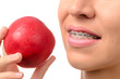 Female teeth with dental braces and red apple