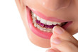 Woman wearing orthodontic removable braces