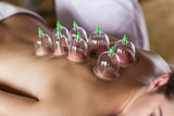 Fototapeta Panele - Woman with cupping treatment on back