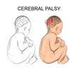 cerebral palsy. neurology