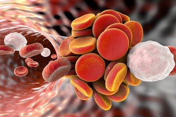 Sticker - Thromboembol in blood vessel. Clot formation. Red blood cells and white blood cells.