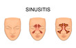 nasal sinus. inflammation