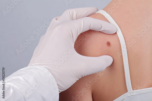 Fotografie, Obraz Doctor dermatologist examines birthmark of patient close up