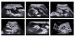 Collage of medical images of ultrasound anomaly scan