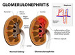 Glomerulonephritis or glomerular nephritis. kidney disease