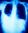 chest radiography is show pleural effusion which seen in lung disease