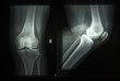 x-ray image normal knee