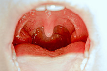 Closeup View Of Open Mouth With Tonsils