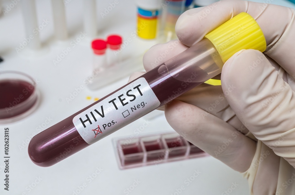 Hand holds test tube for HIV test. - obrazy, fototapety, plakaty 