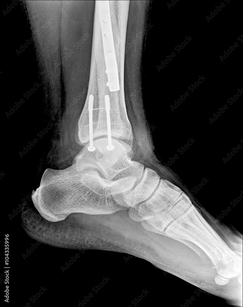X-ray of the broken leg / Many others X-ray images in my portfolio. Stock  Photo | Adobe Stock, image size:793x1000