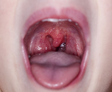 Throat Tonsil