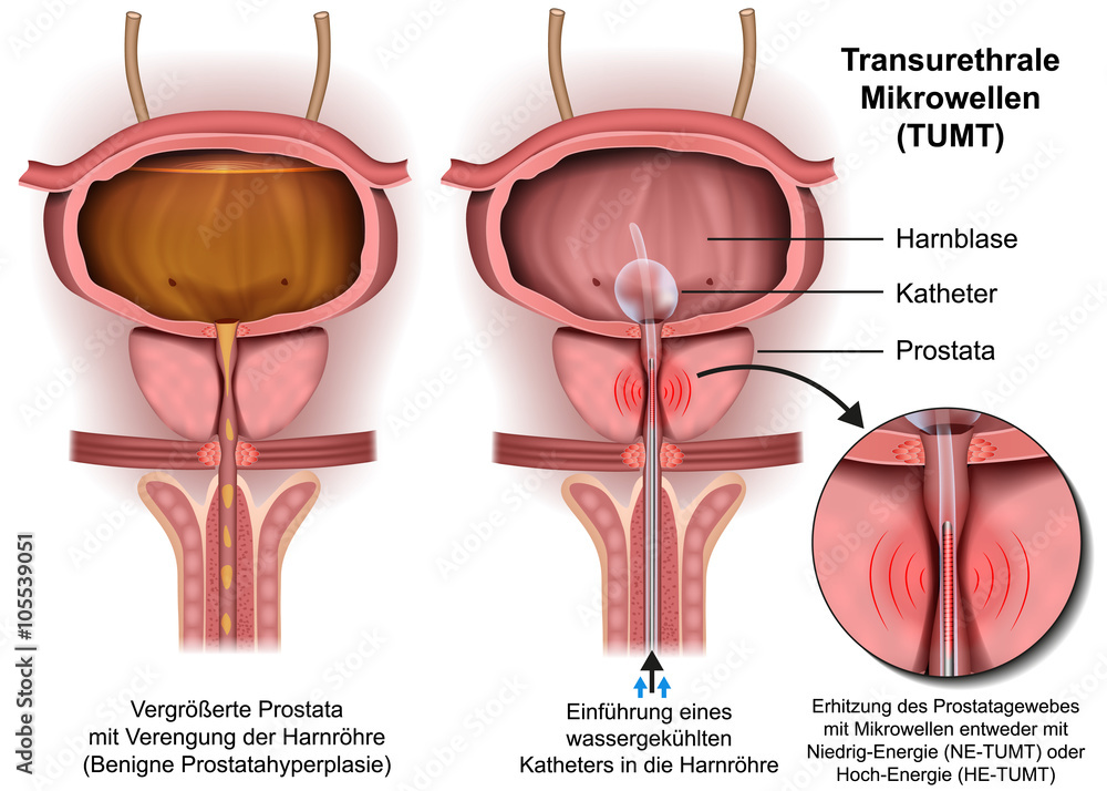 Transurethrale Mikrowellen Tumt Illustration Prostata Operation Sticker Bilderzwerg