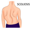 back, a scoliosis of the fourth degree