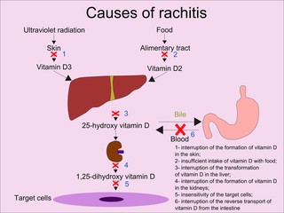 Wall Mural - The most common causes of rachitis  