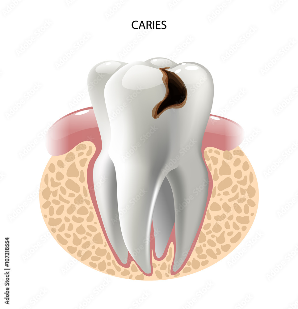vector image tooth caries disease Stock Vector | Adobe Stock