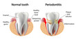 © elenbushe - vector image tooth  Periodontitis disease