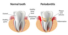 Vector Image Tooth  Periodontitis Disease