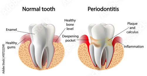Fotografía vector image tooth Periodontitis disease