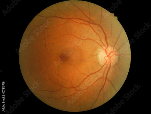 Cuadros en Lienzo Human eye anatomy, retina, optic disc artery and vein etc. takin