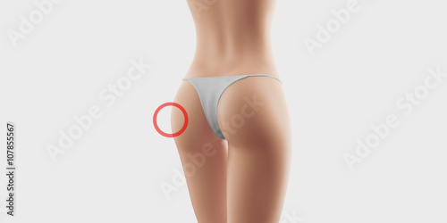 sedere cellulite