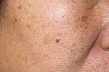 Close up Dry face skin with freckles, acne