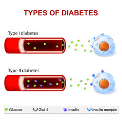 Wall Mural - Types of Diabetes